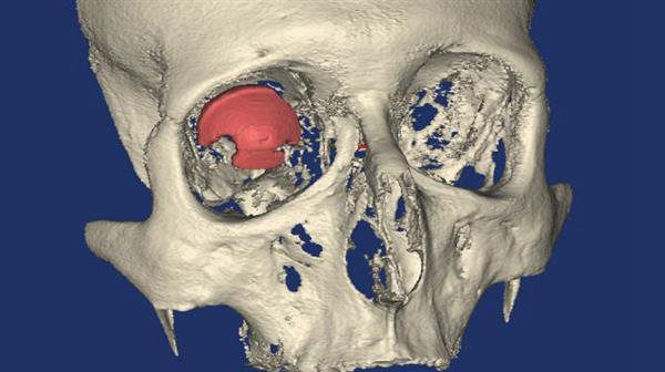 3D打印技術在醫療方面的應用 世界首個3D打印義眼_E鍵3D打印服務