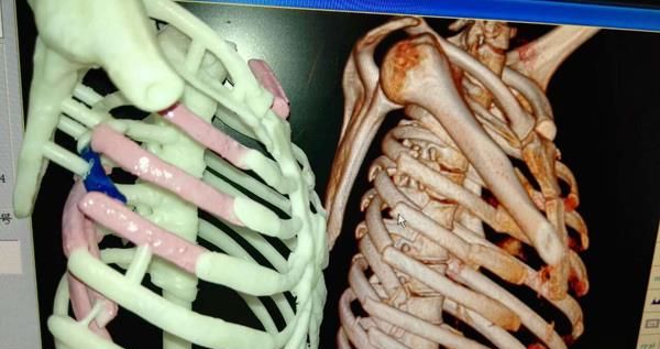 3D打印技術(shù)在醫(yī)療領(lǐng)域的應(yīng)用