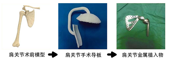 肩關節金屬植入物2